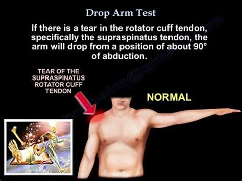 rotator cuff tear test drop arm|empty can test rotator cuff.